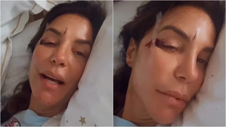 Ivete Sangalo surge com hematomas fala sobre acidente doméstico que sofreu em casa 