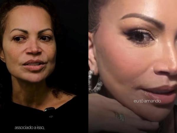Solange Almeida mostra resultado após procedimentos estéticos para rejuvenescimento facial