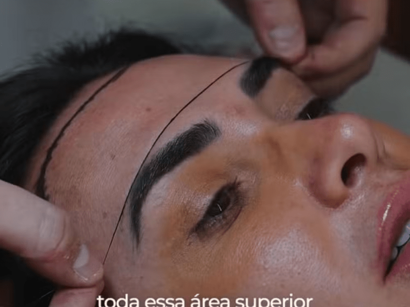 Nicole Bahls realiza transplante capilar após quadro de alopecia: ‘Mais feliz e mais&nbsp;cabeluda’